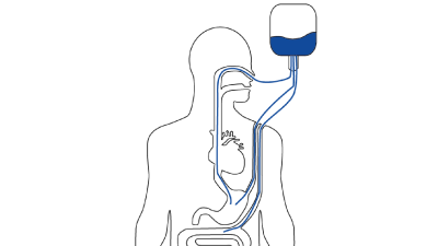 早期腸內營養聯合膳食纖維對重癥肺炎患者腸道微生態的作用研究